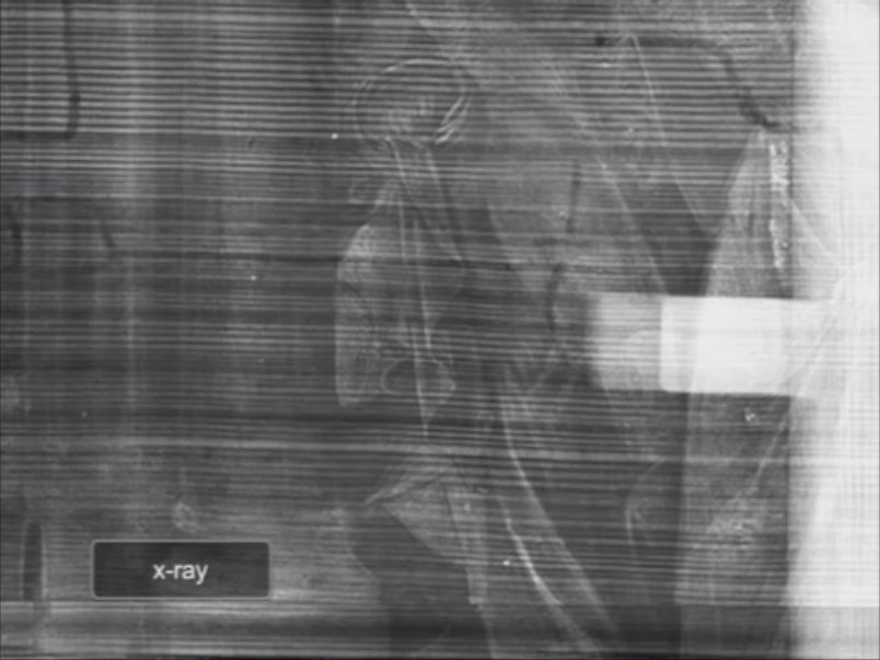 X-ray